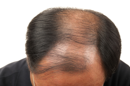 Hair Loss